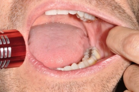 oral cancer